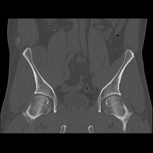 Chondrosarcoma of iliac wing (Radiopaedia 63861-72599 Coronal bone window 54).jpg