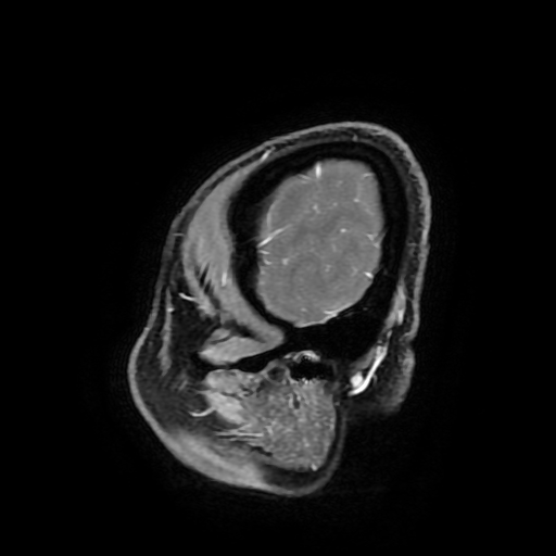 Chordoid glioma of third ventricle (Radiopaedia 91612-109340 F 185).jpg