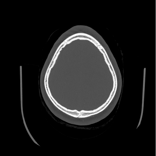 Choroid plexus papilloma extending into the cerebellopontine angle cistern (Radiopaedia 85941-101833 Axial bone window 78).png