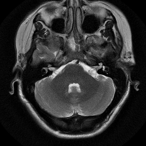 File:Choroid plexus xanthogranuloma (Radiopaedia 17650-17386 T2 19).jpg