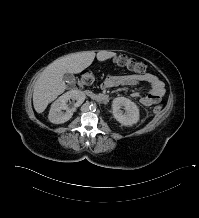 Chromophobe renal cell carcinoma (Radiopaedia 84239-99519 E 84).jpg