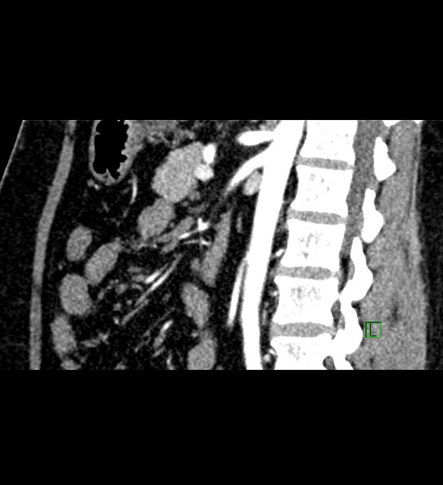 Chromophobe renal cell carcinoma (Radiopaedia 84286-99573 F 77).jpg