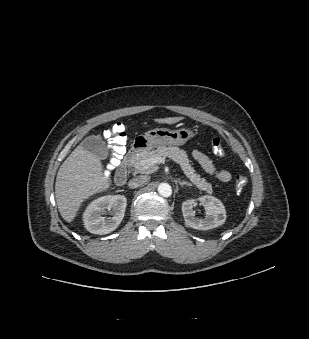 Chromophobe renal cell carcinoma (Radiopaedia 84337-99644 B 33).jpg