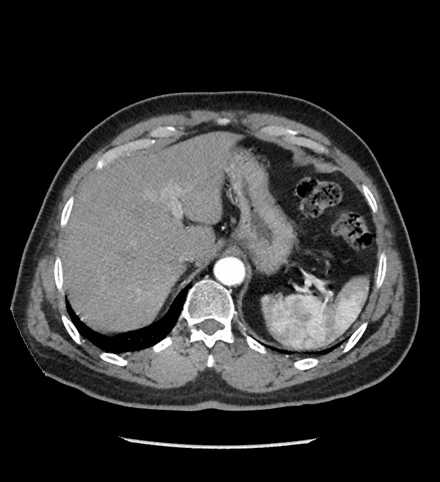 Chromophobe renal cell carcinoma (Radiopaedia 86879-103083 B 30).jpg
