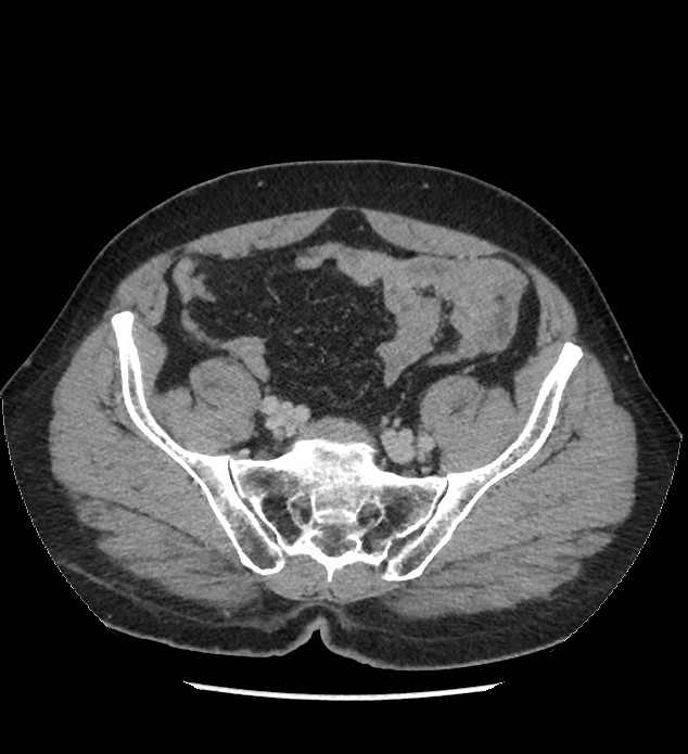 Chromophobe renal cell carcinoma (Radiopaedia 86879-103083 C 117).jpg