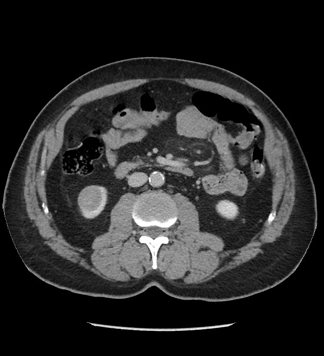 Chromophobe renal cell carcinoma (Radiopaedia 86879-103083 C 70).jpg