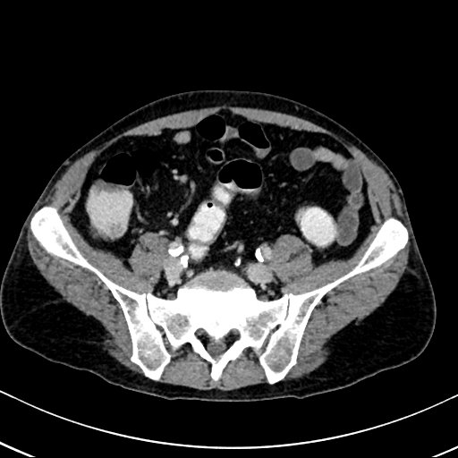 Chronic appendicitis complicated by appendicular abscess, pylephlebitis and liver abscess (Radiopaedia 54483-60700 B 108).jpg