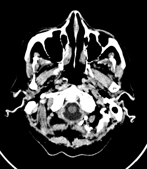 Chronic bilateral subdural hygroma (Radiopaedia 85801-101623 Axial non-contrast 55).jpg