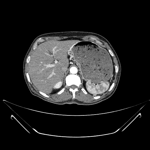File:Chronic contained rupture of abdominal aortic aneurysm with extensive erosion of the vertebral bodies (Radiopaedia 55450-61901 A 1).jpg