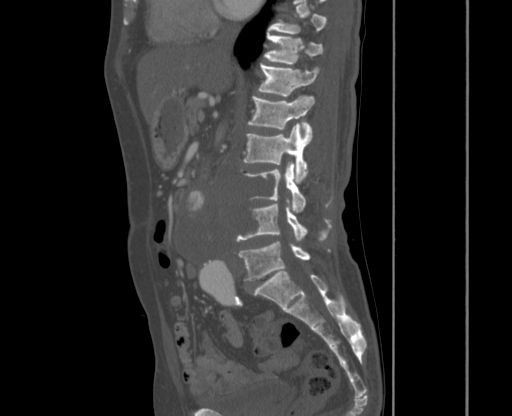File:Chronic contained rupture of abdominal aortic aneurysm with extensive erosion of the vertebral bodies (Radiopaedia 55450-61901 Sagittal bone window 13).jpg