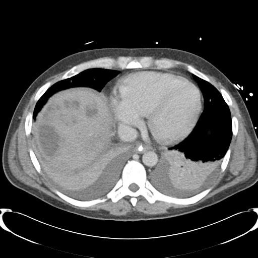 Chronic diverticulitis complicated by hepatic abscess and portal vein thrombosis (Radiopaedia 30301-30938 A 8).jpg