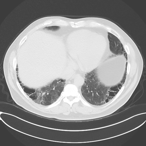 Chronic hypersensitivity pneumonitis (Radiopaedia 48107-52922 Axial lung window 45).png