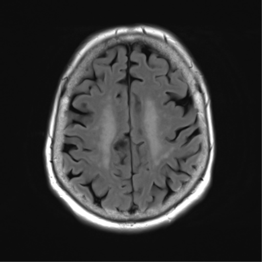 File:Chronic hypertensive encephalopathy (Radiopaedia 39993-42482 Axial FLAIR 21).png