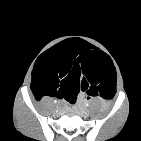 Chronic large bowel pseudo-obstruction (Radiopaedia 43181-46492 A 130).jpg