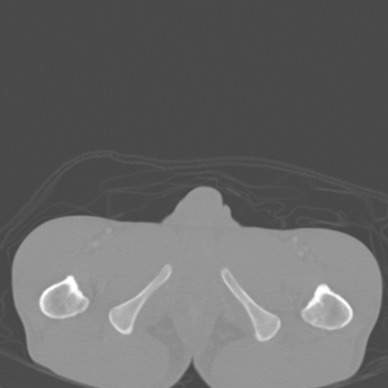 Chronic large bowel pseudo-obstruction (Radiopaedia 43181-46492 Axial bone window 170).jpg