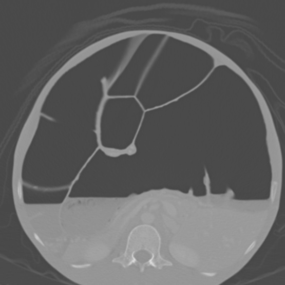 Chronic large bowel pseudo-obstruction (Radiopaedia 43181-46492 Axial bone window 77).jpg