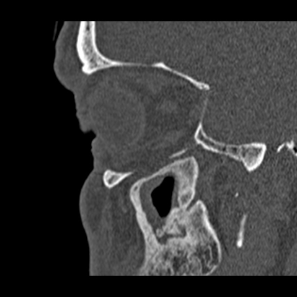 Chronic maxillary sinusitis (Radiopaedia 27879-28116 Sagittal bone window 45).jpg