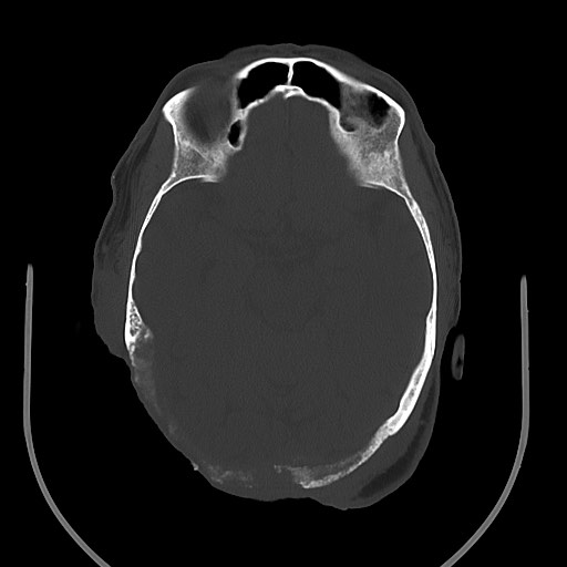 Chronic osteomyelitis - calvarial (severe) (Radiopaedia 69668-79616 Axial bone window 40).jpg