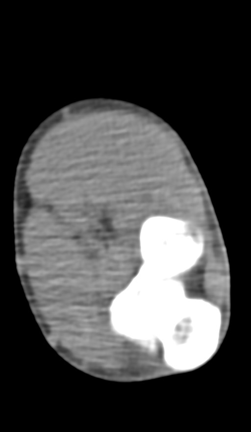 Chronic osteomyelitis of the distal humerus (Radiopaedia 78351-90971 Axial non-contrast 101).jpg