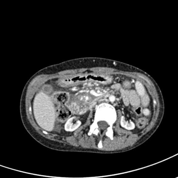 File:Chronic pancreatitis (Radiopaedia 55405-61846 A 44).jpg