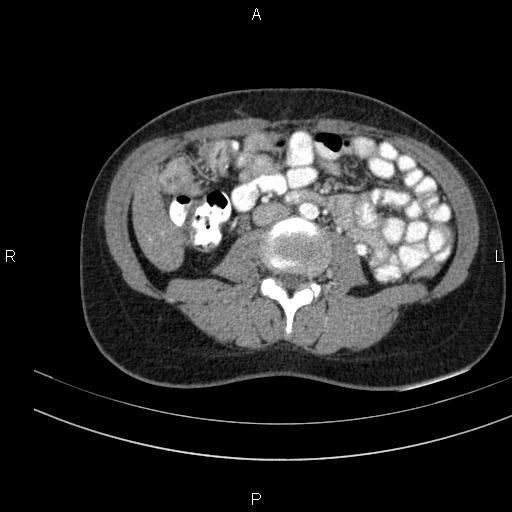 Chronic pancreatitis (Radiopaedia 64576-73450 B 90).jpg