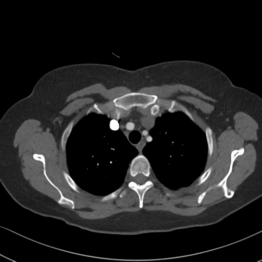 Chronic pulmonary embolus (Radiopaedia 39129-41341 Axial C+ CTPA 23).png