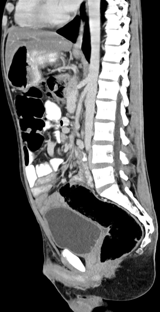Chronic small bowel volvulus (Radiopaedia 75224-86322 C 71).jpg