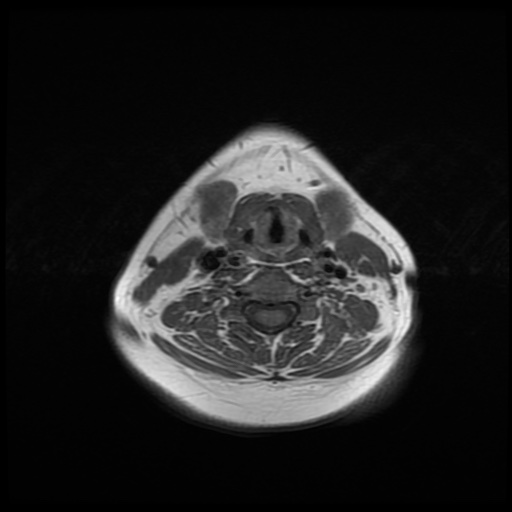 File:Chronic submandibular sialadenitis (Radiopaedia 61852-69885 Axial T1 19).jpg