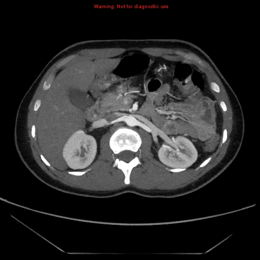 File:Circumaortic left renal vein (Radiopaedia 9069-9792 A 16).jpg