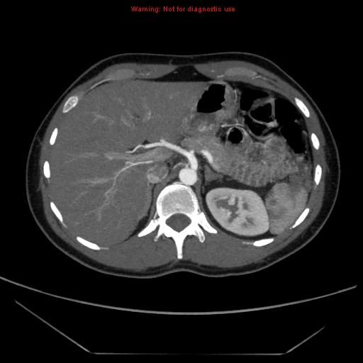 File:Circumaortic left renal vein (Radiopaedia 9069-9792 A 3).jpg