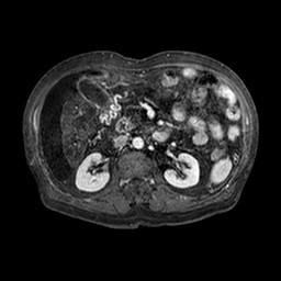File:Cirrhosis and hepatocellular carcinoma in the setting of hemochromatosis (Radiopaedia 75394-86594 Axial T1 C+ fat sat 193).jpg
