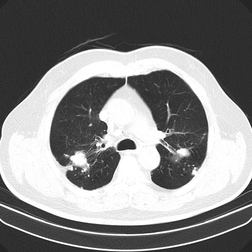 Classic complicated silicosis (Radiopaedia 49720-54961 Axial lung window 20).jpg