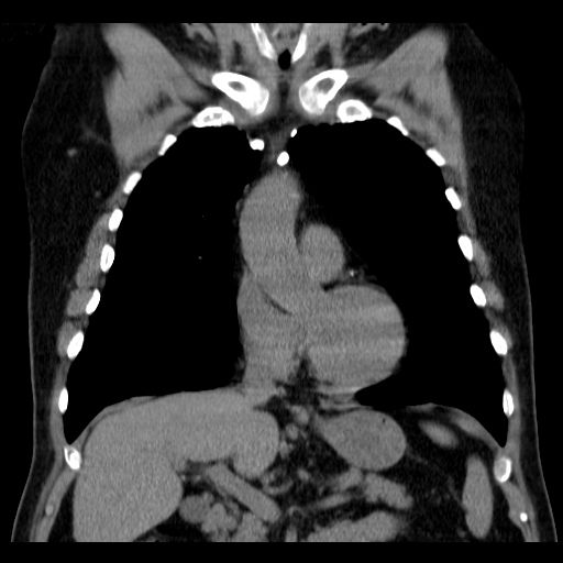 File:Classic complicated silicosis (Radiopaedia 49720-54961 Coronal liver window 21).jpg