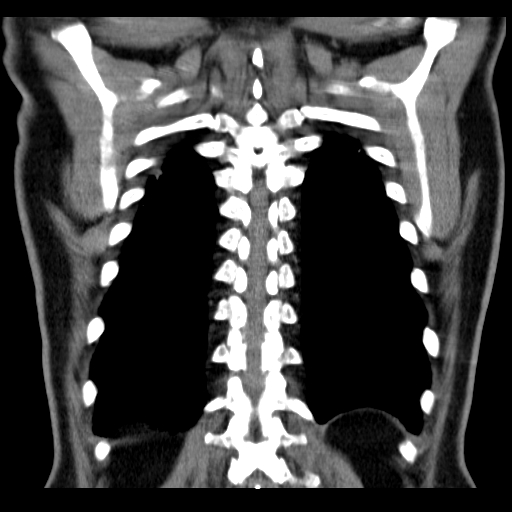 File:Classic complicated silicosis (Radiopaedia 49720-54961 Coronal liver window 53).jpg