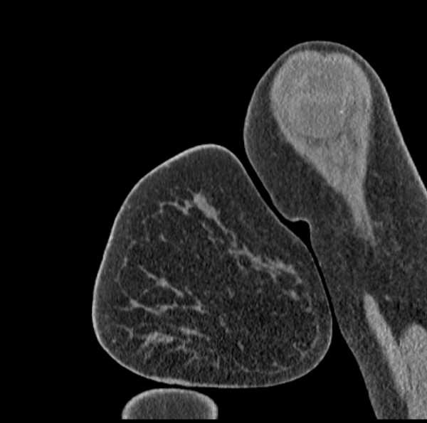 Clear cell chondrosarcoma - humerus (Radiopaedia 63104-71612 D 8).jpg