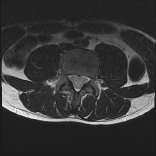 File:Clear cell meningoma - lumbar spine (Radiopaedia 60116-67690 Axial T2 17).png