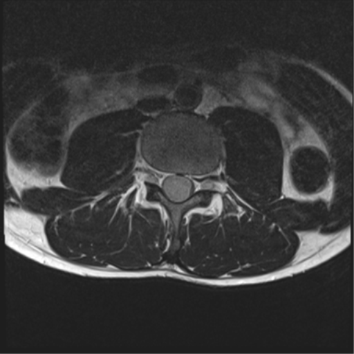 File:Clear cell meningoma - lumbar spine (Radiopaedia 60116-67690 Axial T2 21).png