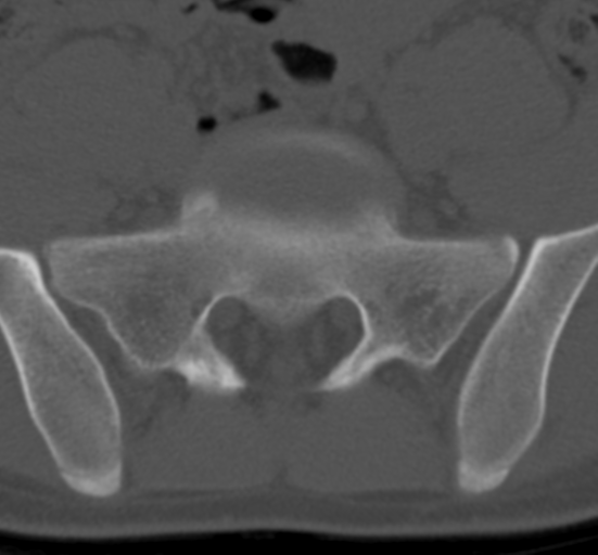 Clear cell meningoma - lumbar spine (Radiopaedia 60116-67691 Axial bone window 69).png