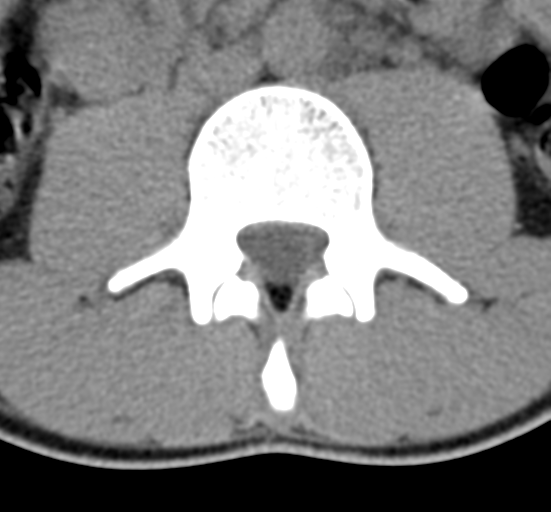 File:Clear cell meningoma - lumbar spine (Radiopaedia 60116-67691 Axial non-contrast 36).png