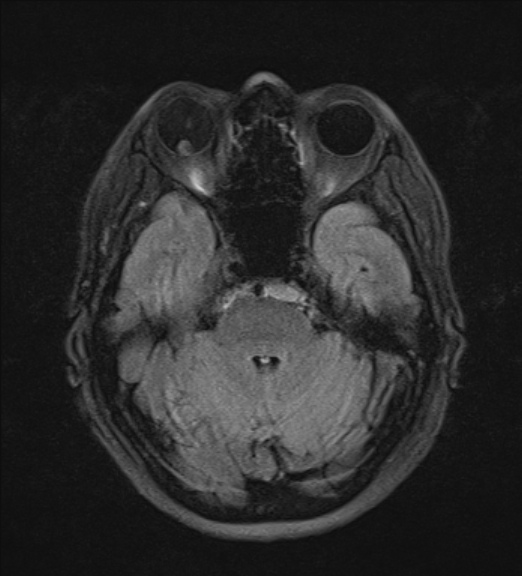 File:Clival meningioma (Radiopaedia 53278-59248 Axial FLAIR 7).jpg