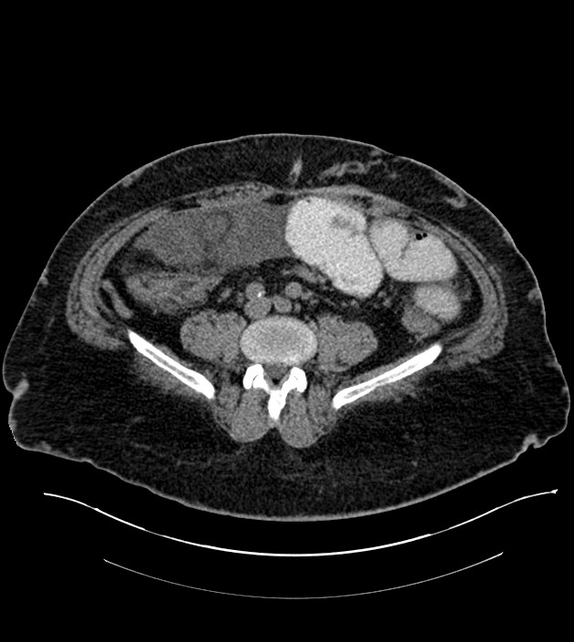 Closed-loop small bowel obstruction-internal hernia (Radiopaedia 78439-91096 Axial non-contrast 102).jpg