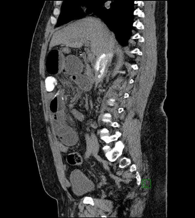 Closed-loop small bowel obstruction-internal hernia (Radiopaedia 78439-91096 C 86).jpg