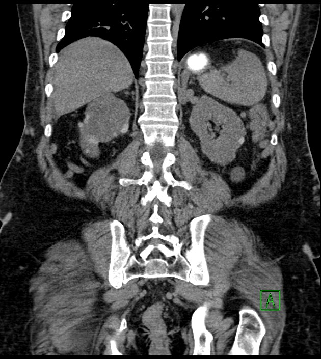 Closed-loop small bowel obstruction-internal hernia (Radiopaedia 78439-91096 Coronal non-contrast 75).jpg