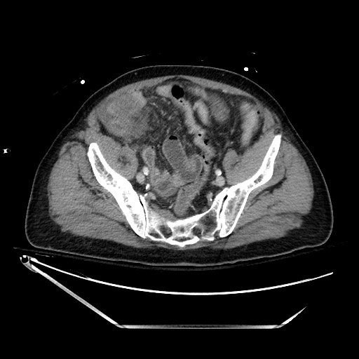 Closed loop obstruction due to adhesive band, resulting in small bowel ischemia and resection (Radiopaedia 83835-99023 D 123).jpg