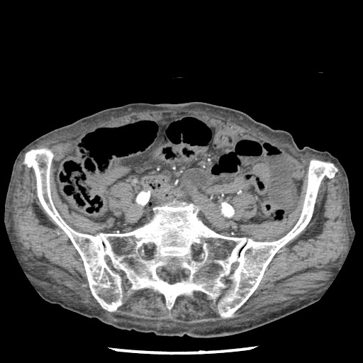 Closed loop small bowel obstruction - adhesions and infarct (Radiopaedia 85125-100678 A 131).jpg
