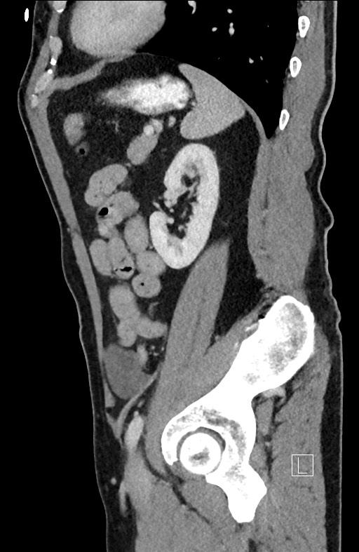 Closed loop small bowel obstruction - internal hernia (Radiopaedia 57806-64778 C 35).jpg