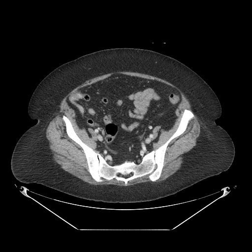 Closed loop small bowel obstruction - internal hernia (Radiopaedia 65402-74450 A 101).jpg