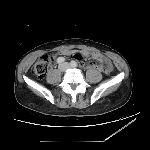 Closed loop small bowel obstruction - omental adhesion causing "internal hernia" (Radiopaedia 85129-100682 A 108).jpg
