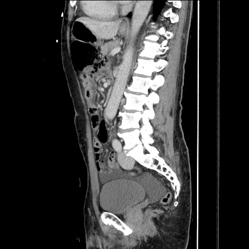 Closed loop small bowel obstruction - omental adhesion causing "internal hernia" (Radiopaedia 85129-100682 C 103).jpg