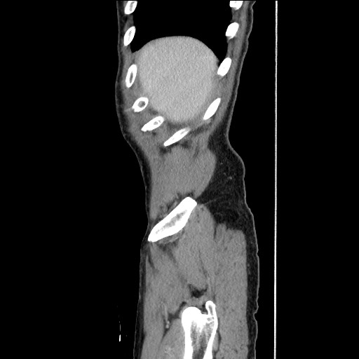 Closed loop small bowel obstruction - omental adhesion causing "internal hernia" (Radiopaedia 85129-100682 C 30).jpg